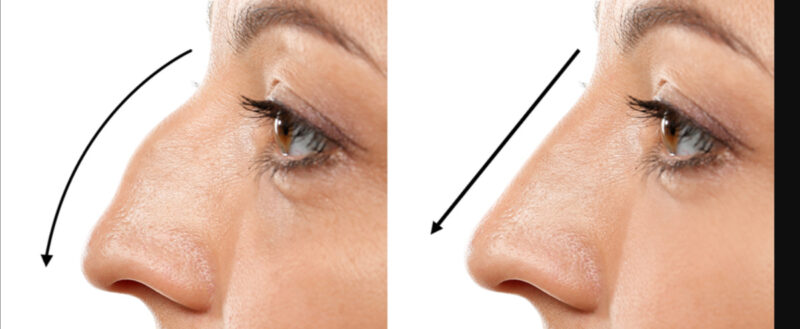 Rhinoplasty