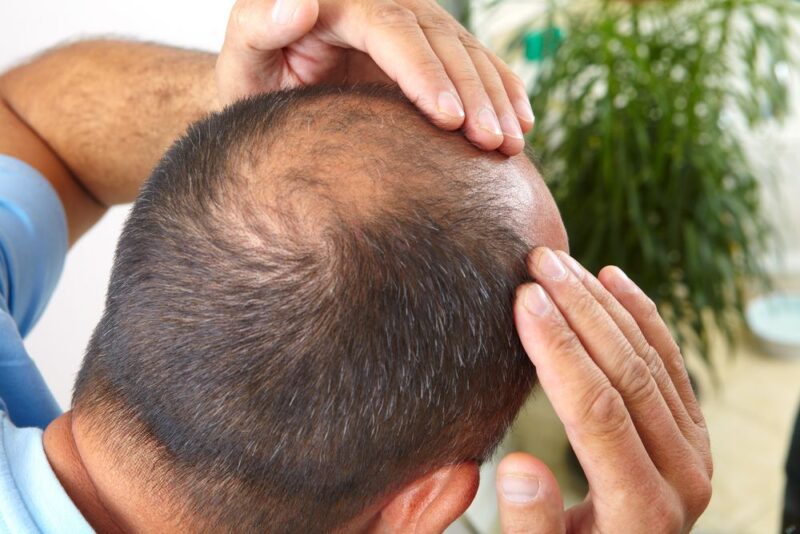 Hair Transplants Baton Rouge: A Complete Guide