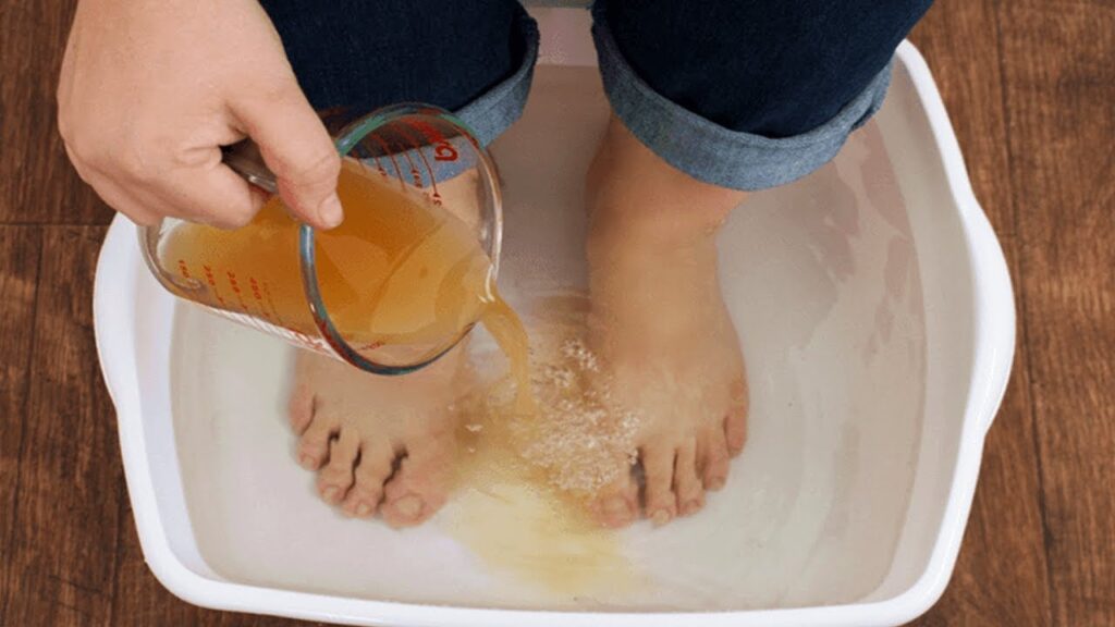 Apple Cider Vinegar For Swollen Feet