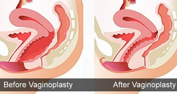 Virgin Tightening Surgery Before and After Pictures